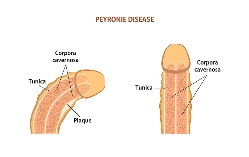 Peyronies Disease